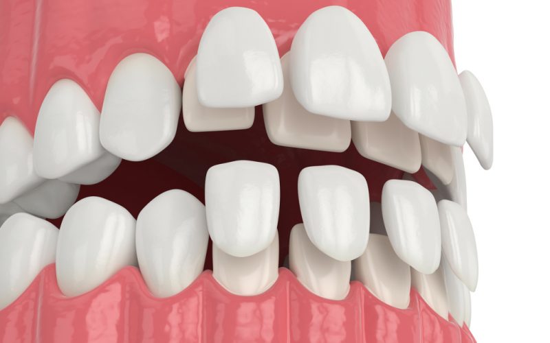 Porcelain Veneers Melbourne