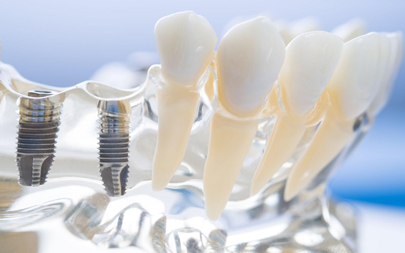 Dental implants
