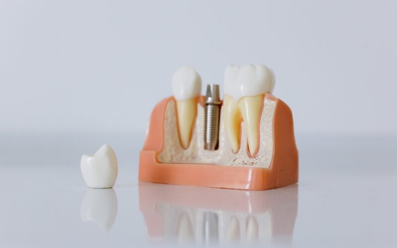 Dental Crowns Preston