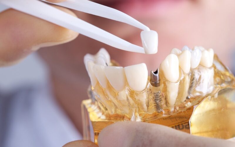 Dental Implants Melbourne